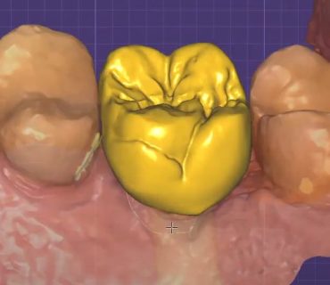 DENTE cadcam